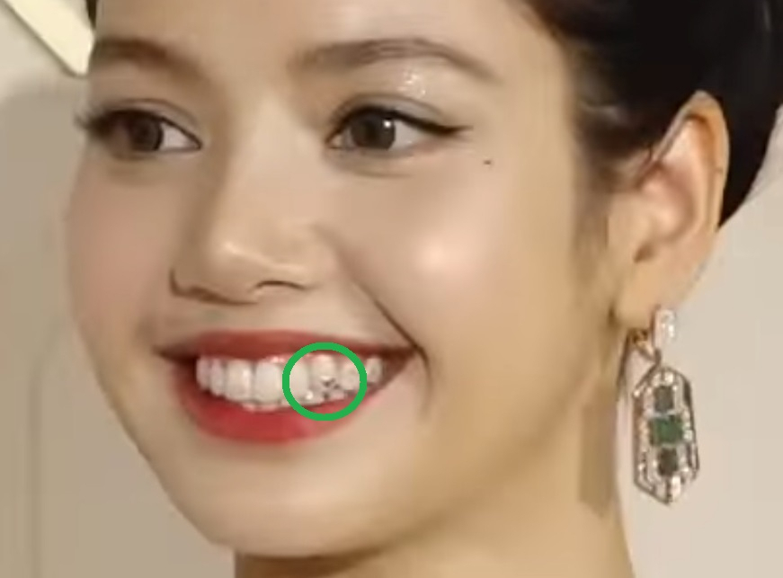 タトゥーはもう古い？LISA（BLACKPINK）の歯に注目…MZ世代必須のファッションアイテム“トゥースジェム” | K-POP、韓国エンタ ...