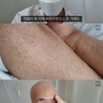白血病を告白した“ソンミのダンサー”チャ・ヒョンスン、退院後すぐに再入院の厳しい闘病生活を報告…「毛細血管が破裂」 白血病を告白した“ソンミのダンサー”チャ・ヒョンスン、退院後すぐに再入院の厳しい闘病生活を報告…「毛細血管が破裂」